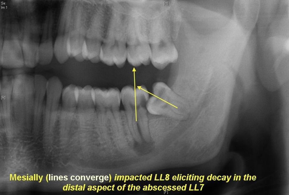 Digital X-ray of impacted wisdom tooth at Aster Smiles Dental Clinic Guzape Abuja