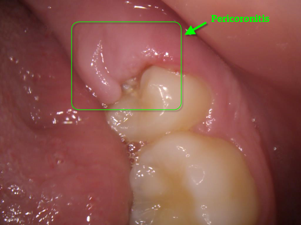 Pericoronitis Treatment Guzape | Fast Relief Aster Smiles