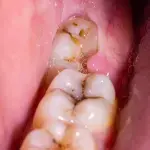 PERICORONITIS