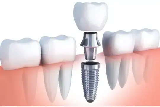 Teeth Replacement Options