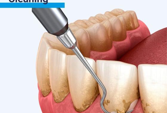 Dental Deep Cleaning (Scaling & Root Planing) in Abuja
