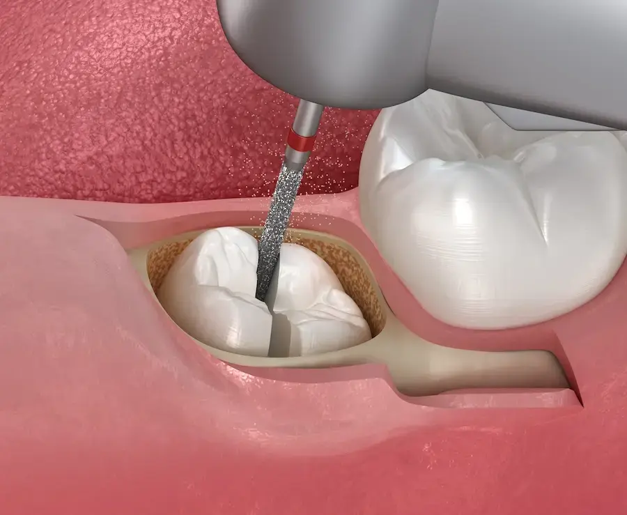 Expert surgical tooth extraction  Abuja