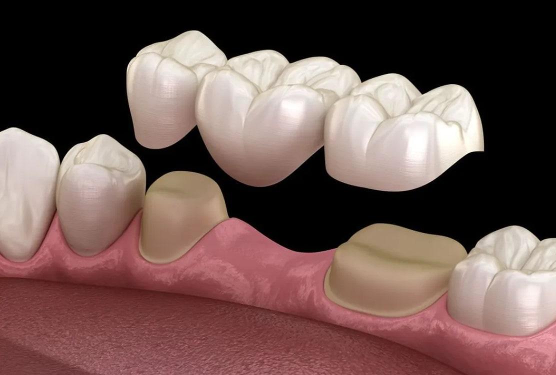 Dental bridge treatment in Guzape Abuja at Aster Smiles Dental Clinic