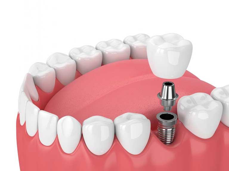 Dental implants in Guzape Abuja at Aster Smiles Dental Clinic