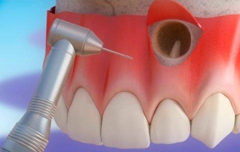 Apicoectomy root-end surgery in Guzape Abuja at Aster Smiles Dental Clinic