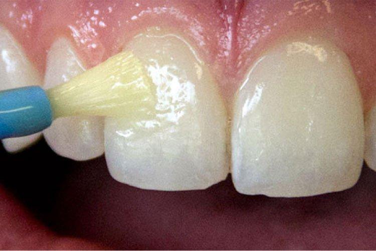 Dental fluoride treatment in Guzape Abuja at Aster Smiles Dental Clinic