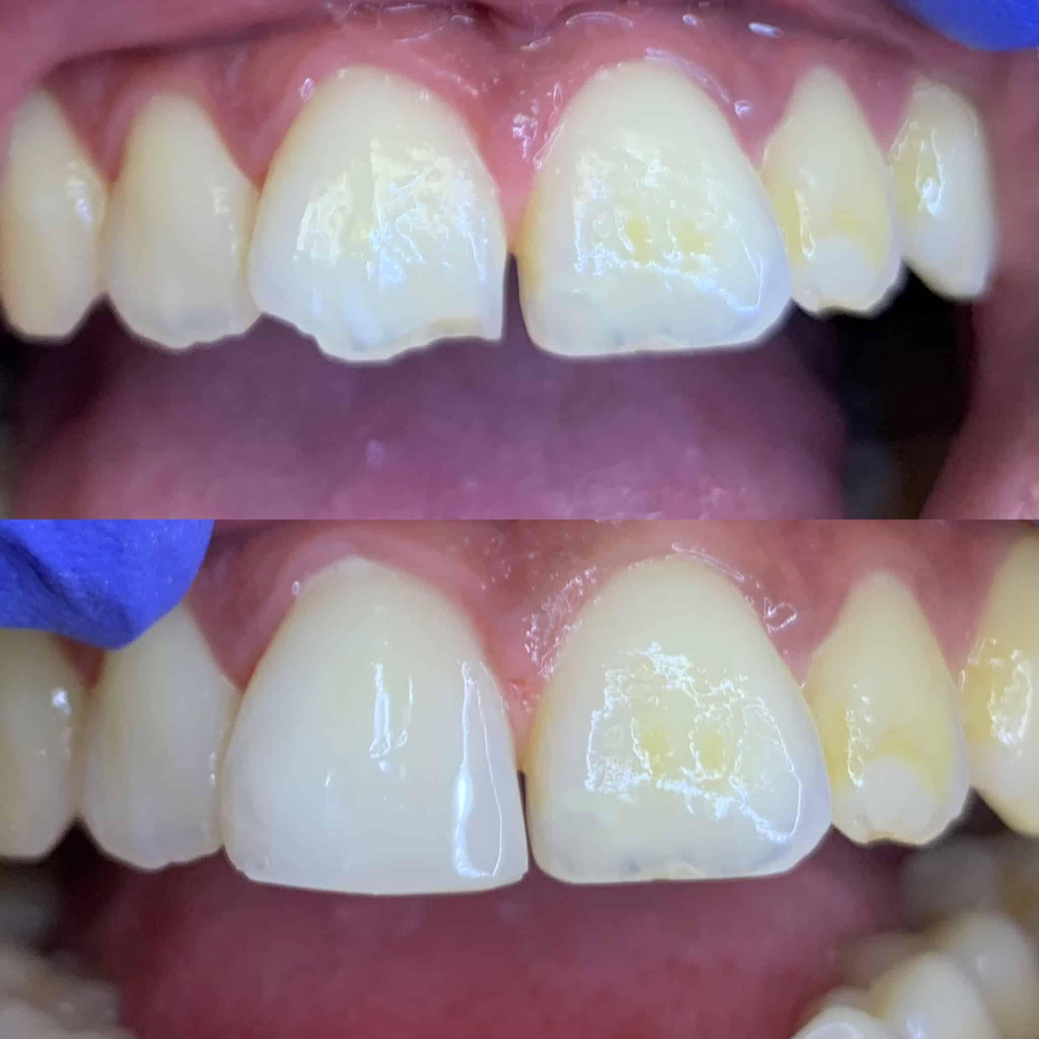 Composite buildup and tooth restoration in Guzape Abuja at Aster Smiles Dental Clinic