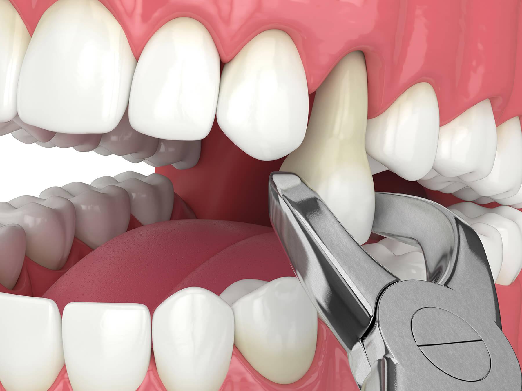 Gentle tooth extraction and aftercare at Aster Smiles Abuja