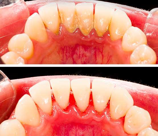 Dental root planing in Guzape Abuja at Aster Smiles Dental Clinic